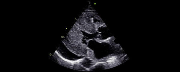 Ecocardiografia nas cardiomiopatias